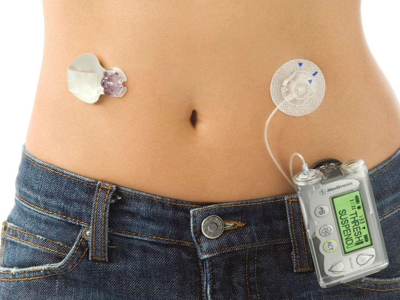 female-waist-with-medtronic-insulin-pump