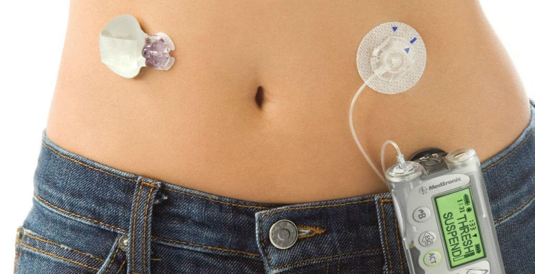 female-waist-with-medtronic-insulin-pump